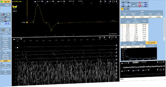 Needle EMG & MUP