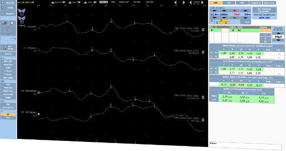 Evoked Potentials