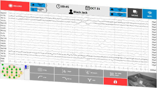 TruScan EEG Acquisition in ICU Mode